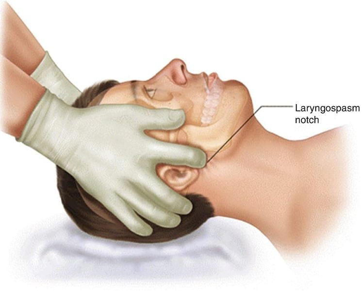 Larson's notch (laryngospasm notch) — pressure point behind the ear lobe